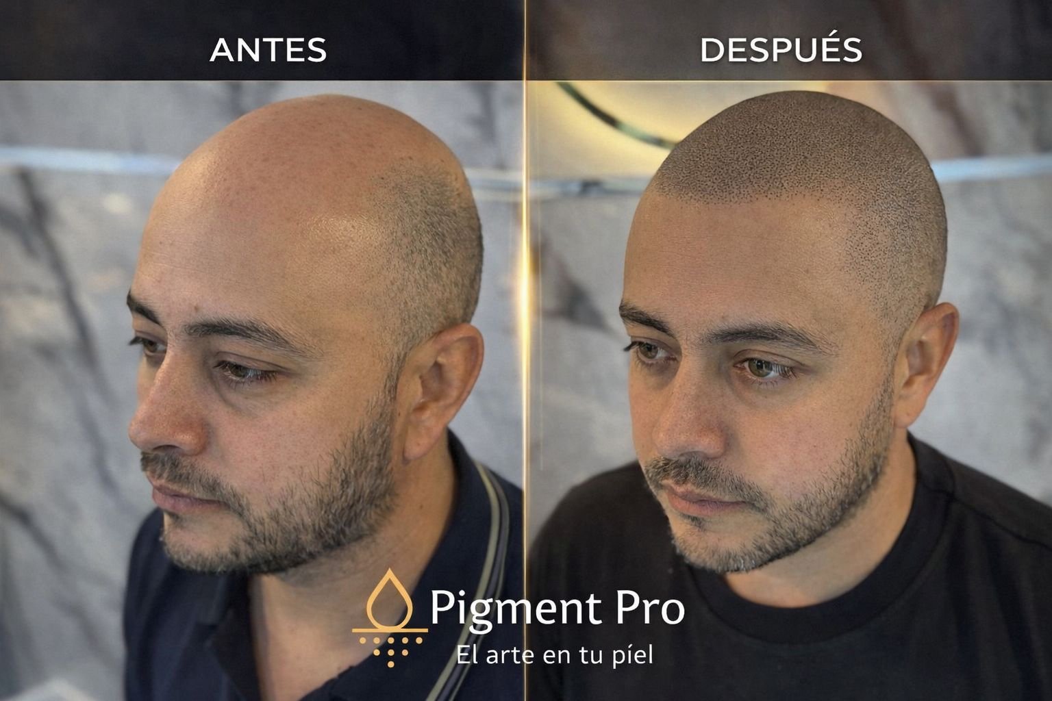 Antes y después micropigmentación capilar alopecia vista lateral - transformación natural Colombia