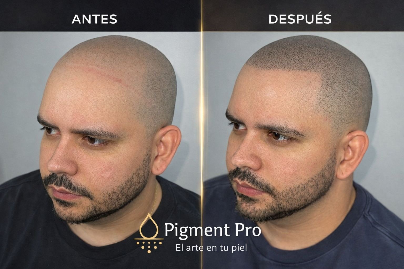 Antes y después micropigmentación de cabeza cicatriz - camuflaje y densidad capilar Pigment Pro Colombia