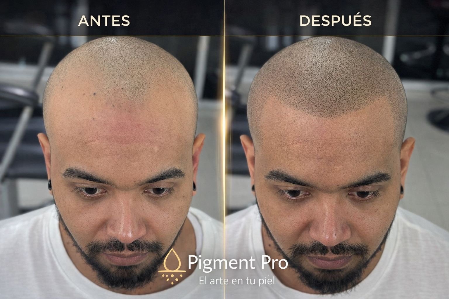 Antes y después micropigmentación capilar entradas frontales - resultado natural Pigment Pro Colombia