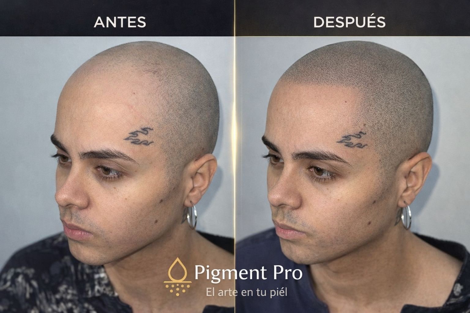 Antes y después micropigmentación capilar en hombres vista lateral - resultado natural Colombia